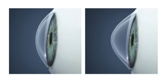 Prevenzione del ‘Cheratocono’ per gli studenti dell’Ic di Monteprandone